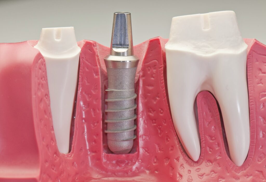 5 Reasons Why Dental Implants Could Be the Perfect Choice for Your Smile