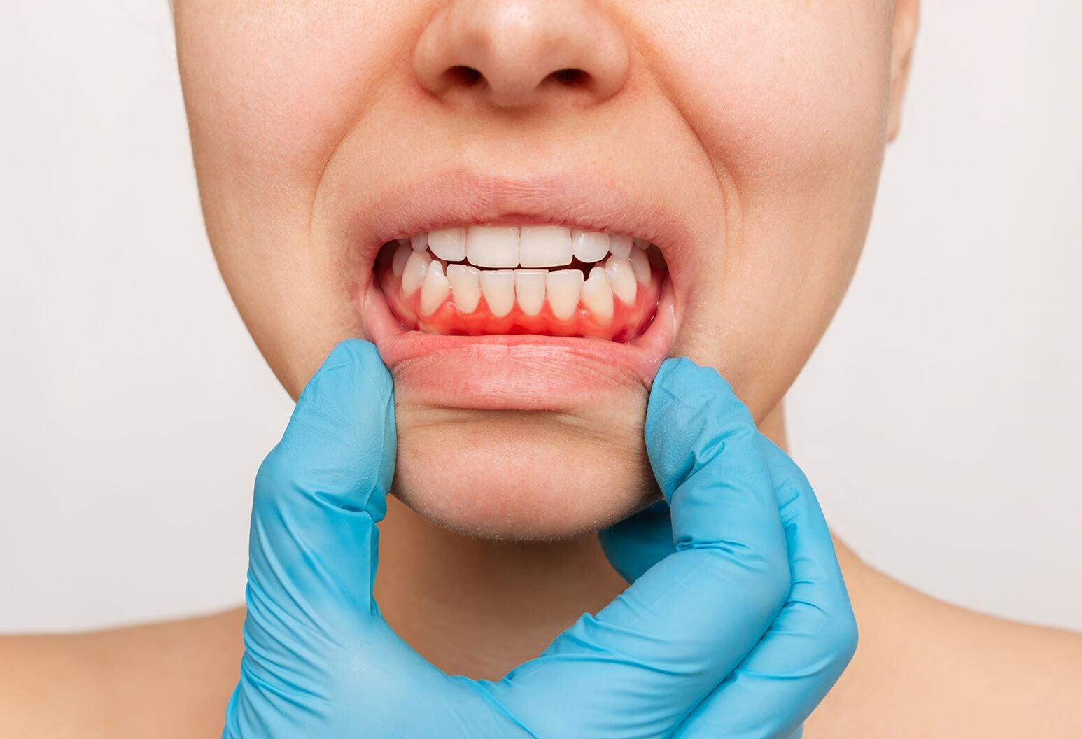 Gingivitis vs. Periodontitis: What’s the Difference?