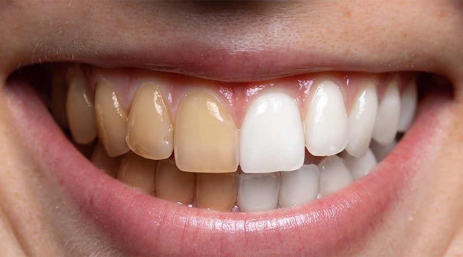 How Does Teeth Whitening Work?