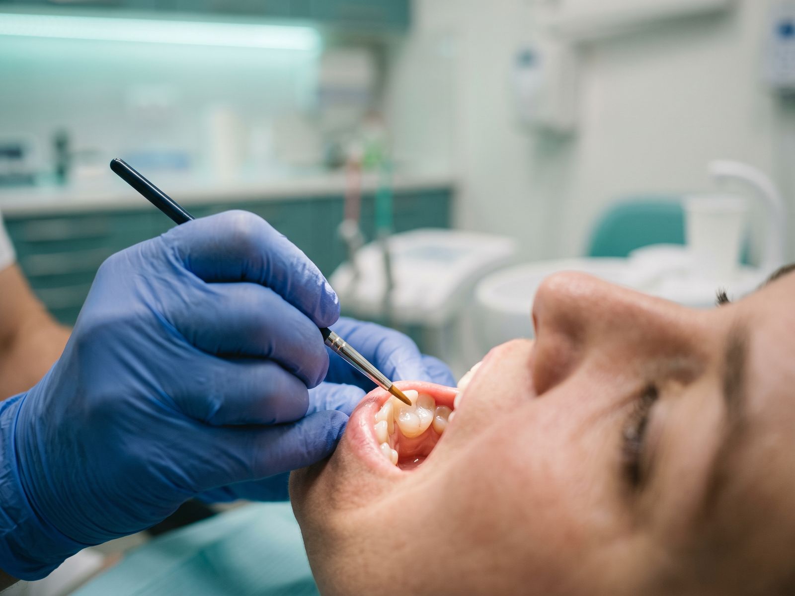 A dentist applying protective dental sealant to a patient's back molar with a fine applicator brush