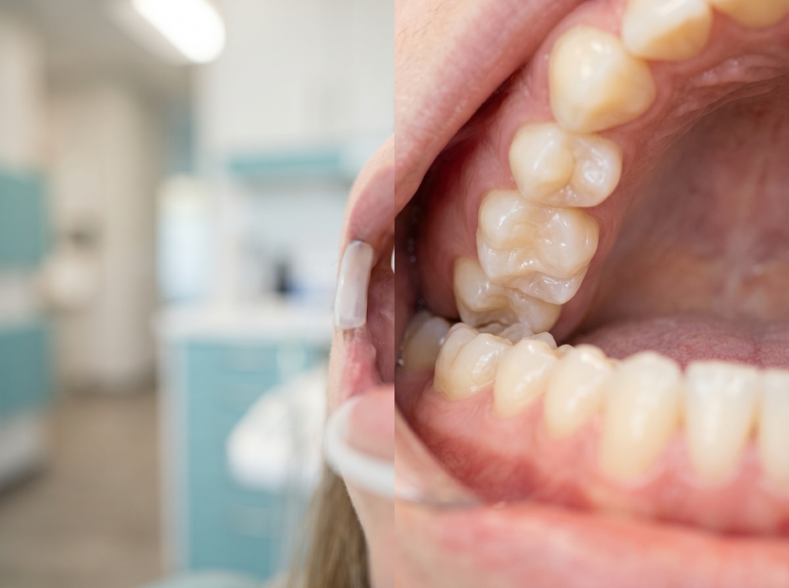 A close view of healthy molars with smooth, sealed chewing surfaces under bright clinical light