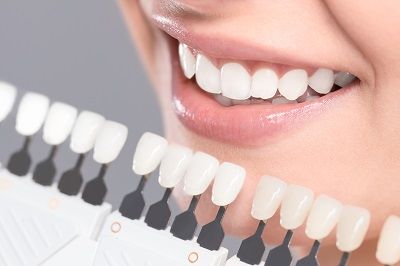 benefits of dental veneers in waterloo on