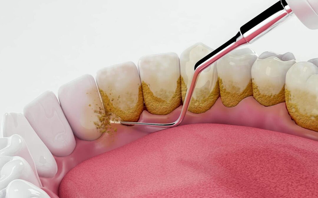 Importance of Regular Teeth Cleaning