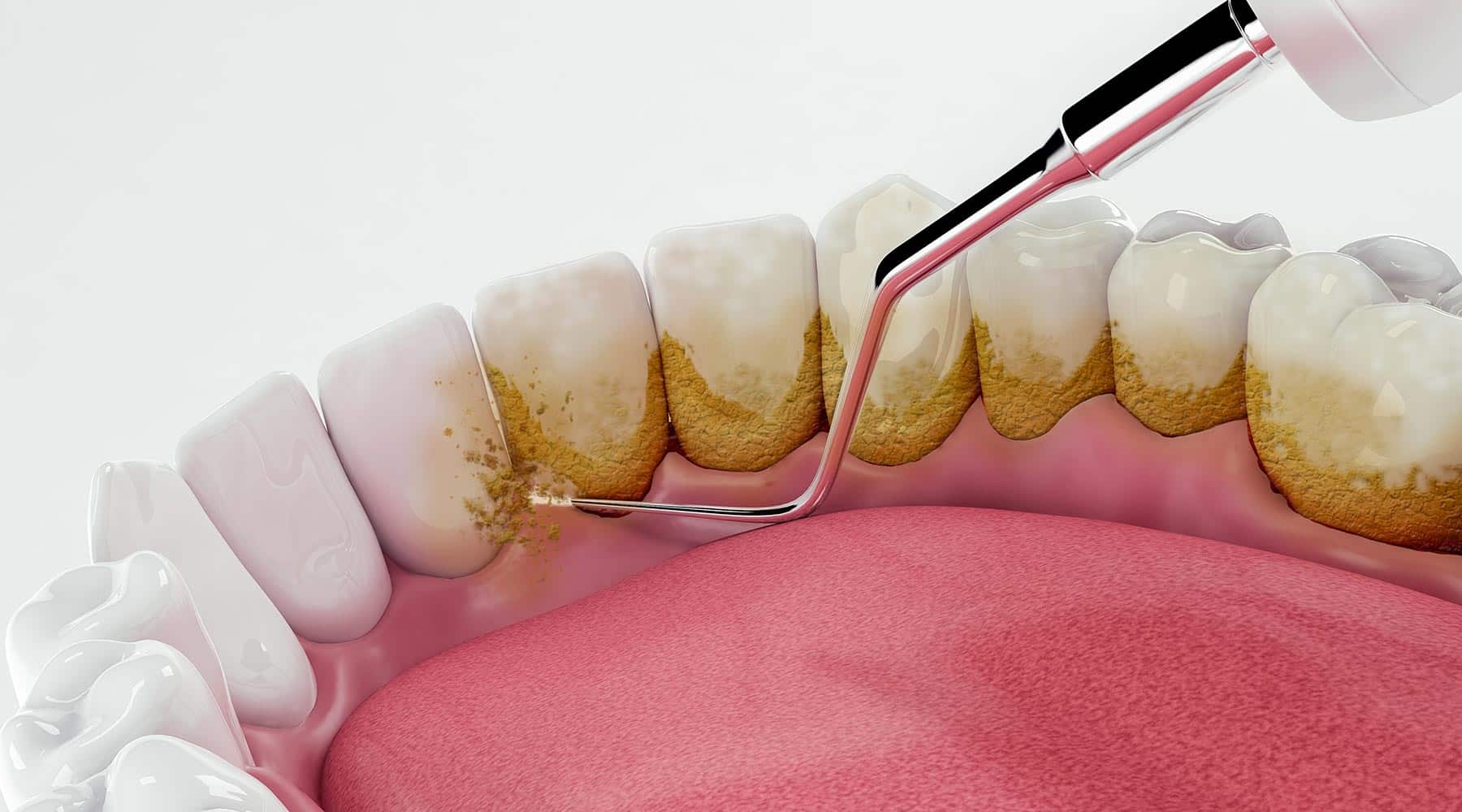 teeth cleaning in waterloo teeth cleaning in waterloo