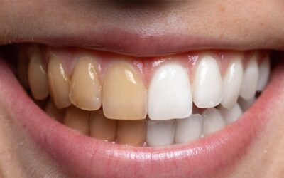 How Does Teeth Whitening Work?